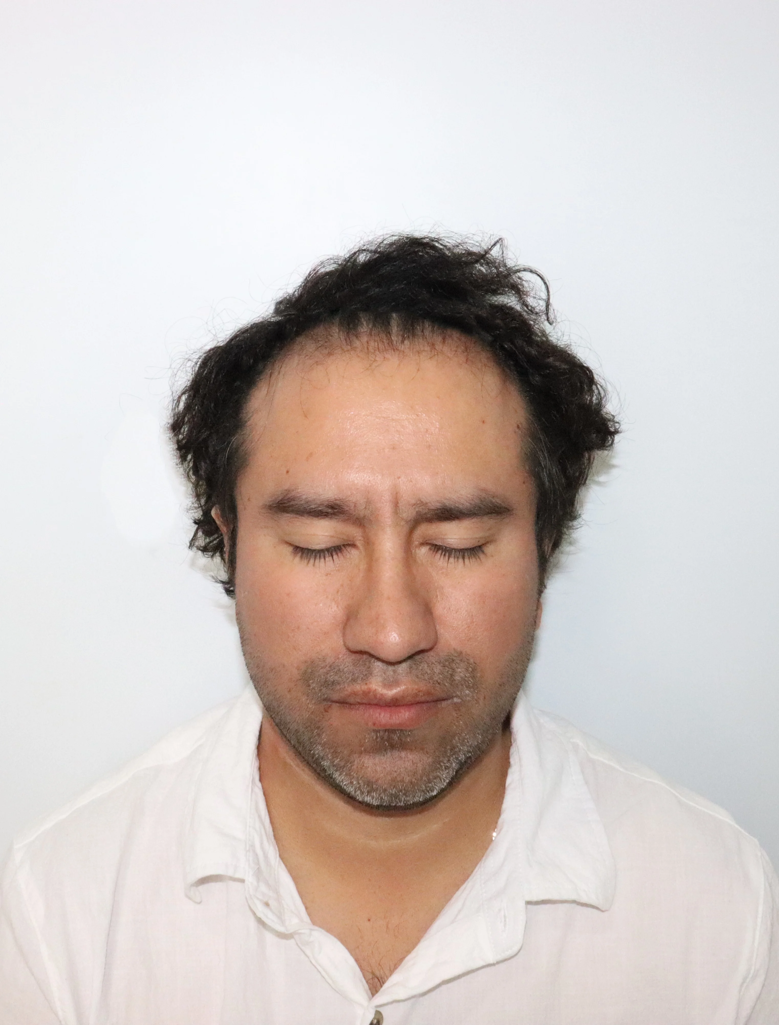 Paciente 4 - Técnica FUE - Antes
