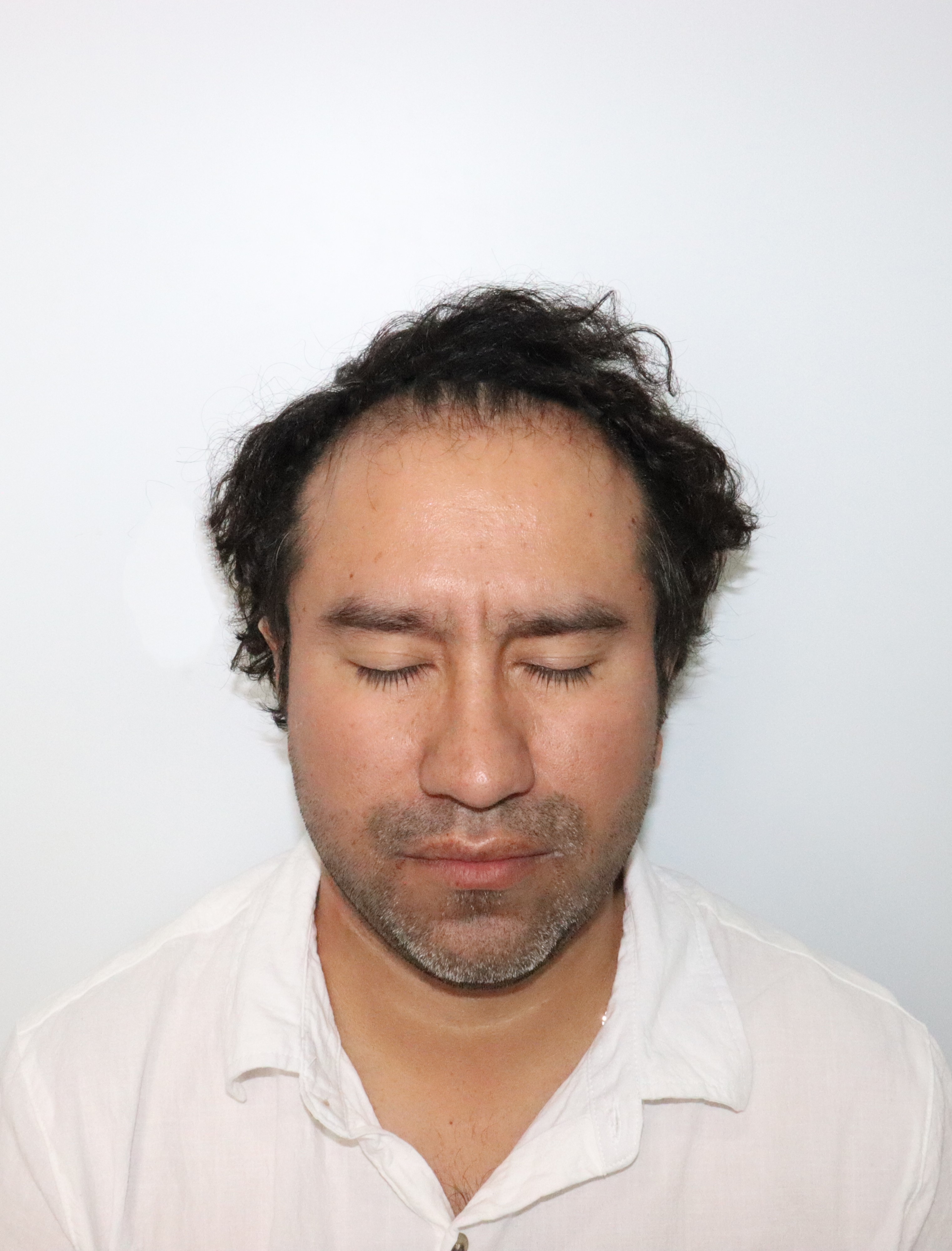 Antes del tratamiento - Caso 4